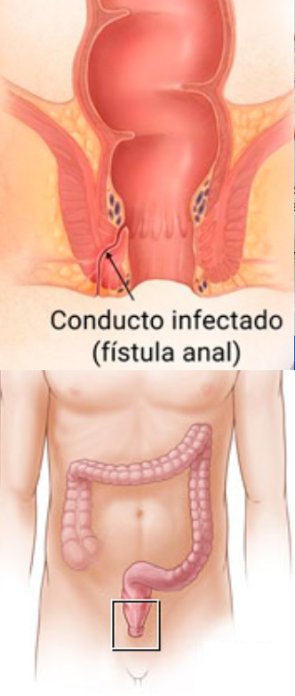 Fistula anorrectal