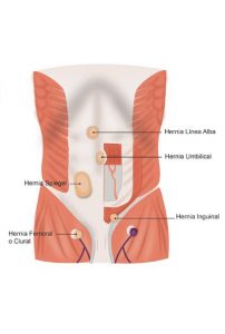 hernia vista muscular